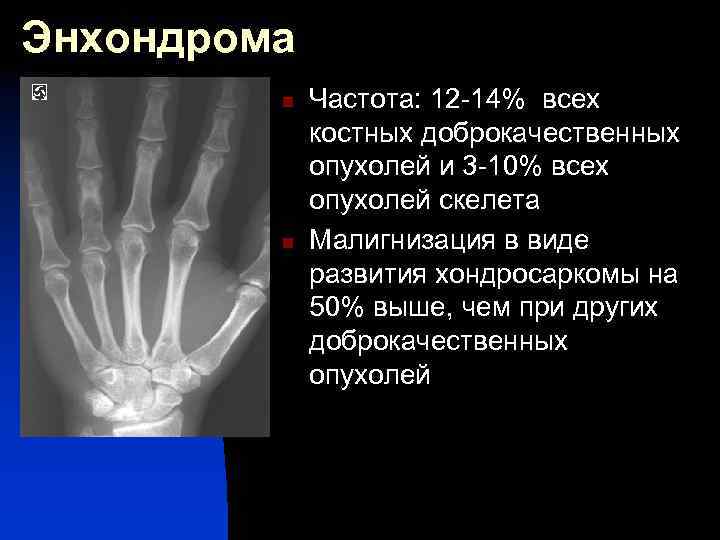 Энхондрома n n Частота: 12 -14% всех костных доброкачественных опухолей и 3 -10% всех