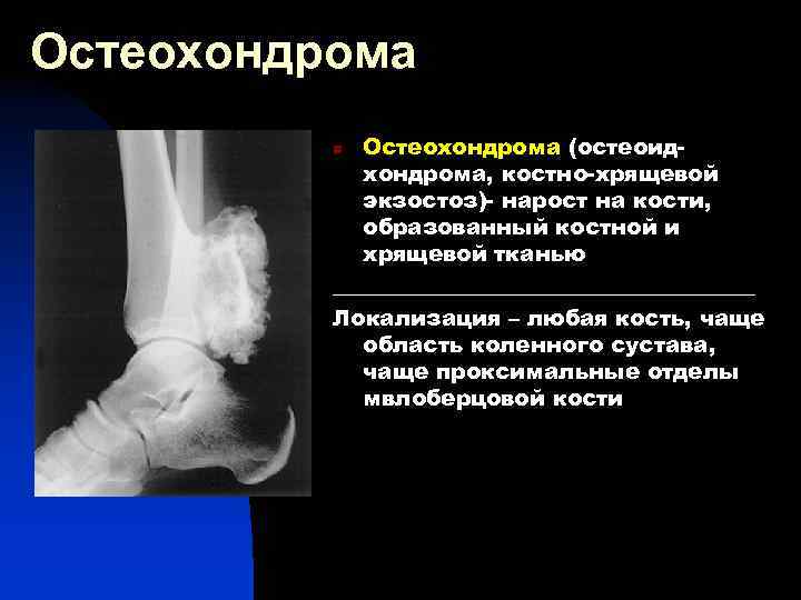 Остеохондрома (остеоидхондрома, костно-хрящевой экзостоз)- нарост на кости, образованный костной и хрящевой тканью ___________________ Локализация