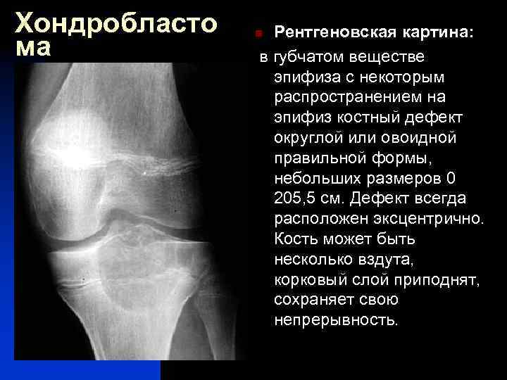 Хондробласто ма Рентгеновская картина: в губчатом веществе эпифиза с некоторым распространением на эпифиз костный