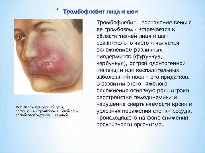 * Рис. Карбункул верхней губы, осложненный тромбозом лицевой вены. резкий отек окружающих тканей Тромбофлебит