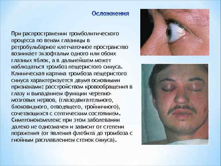 При распространении тромболитического процесса по венам глазницы в ретробульбарное клетчаточное пространство возникает экзофтальм одного