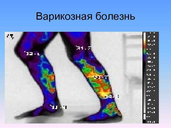 Варикозная болезнь 