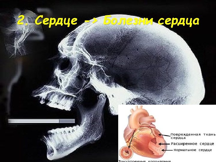 2. Сердце -> Болезни сердца 
