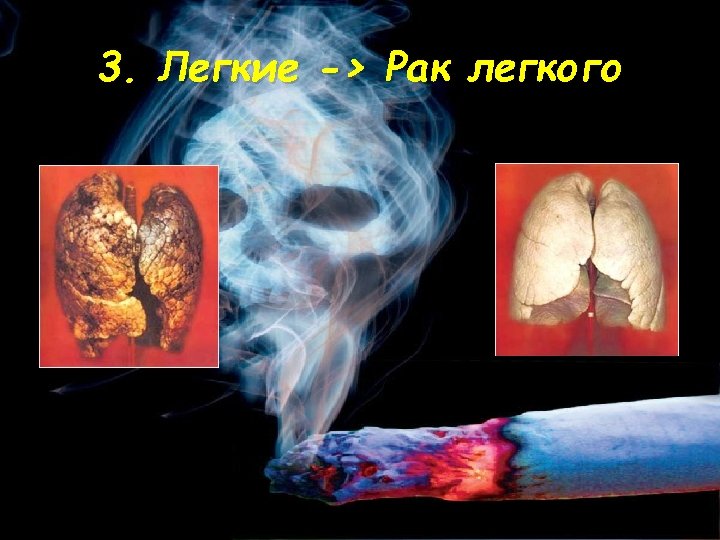 3. Легкие -> Рак легкого 