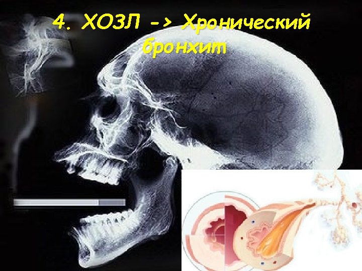 4. ХОЗЛ -> Хронический бронхит 
