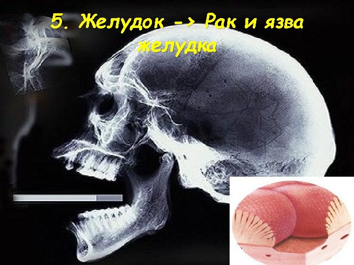 5. Желудок -> Рак и язва желудка 