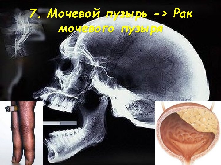 7. Мочевой пузырь -> Рак мочевого пузыря 