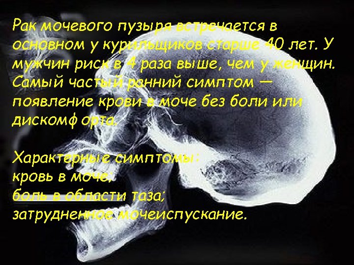 Рак мочевого пузыря встречается в основном у курильщиков старше 40 лет. У мужчин риск