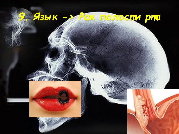 9. Язык -> Рак полости рта 