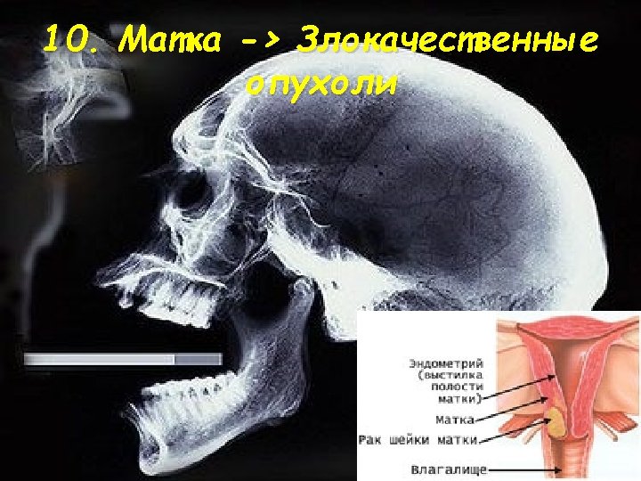 10. Матка -> Злокачественные опухоли 