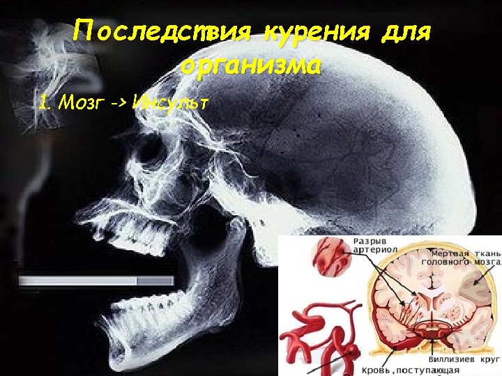 Последствия курения для организма 1. Мозг -> Инсульт 