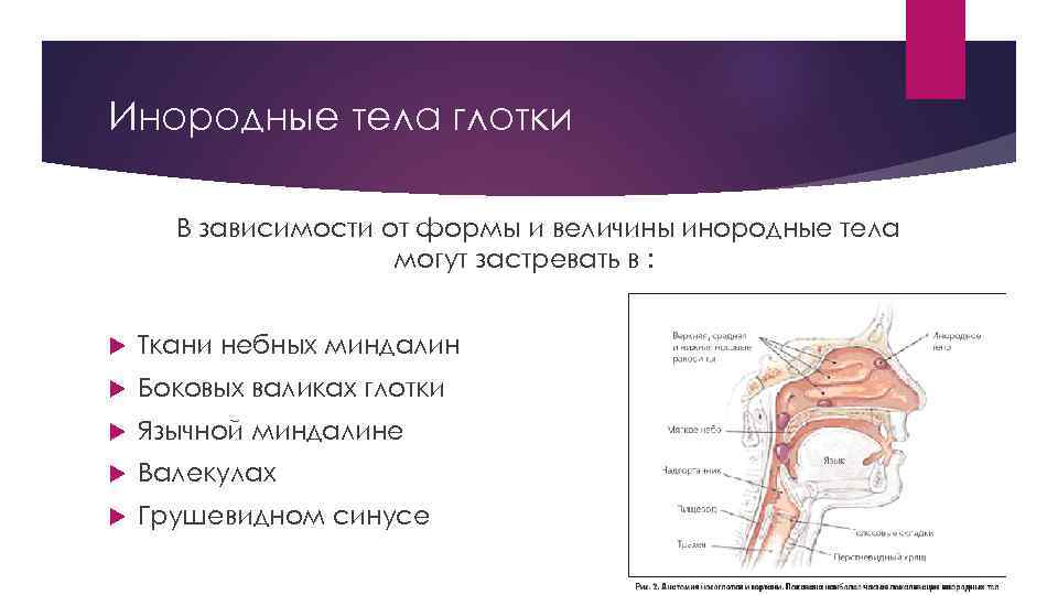 Инородные тела глотки В зависимости от формы и величины инородные тела могут застревать в