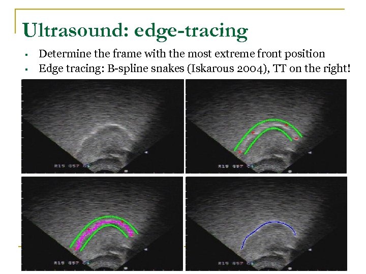 Ultrasound: edge-tracing § § Determine the frame with the most extreme front position Edge