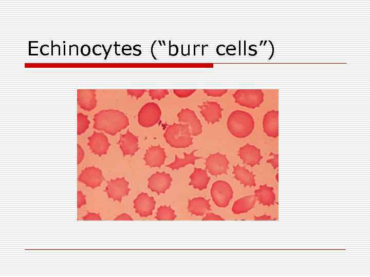 Echinocytes (“burr cells”) 