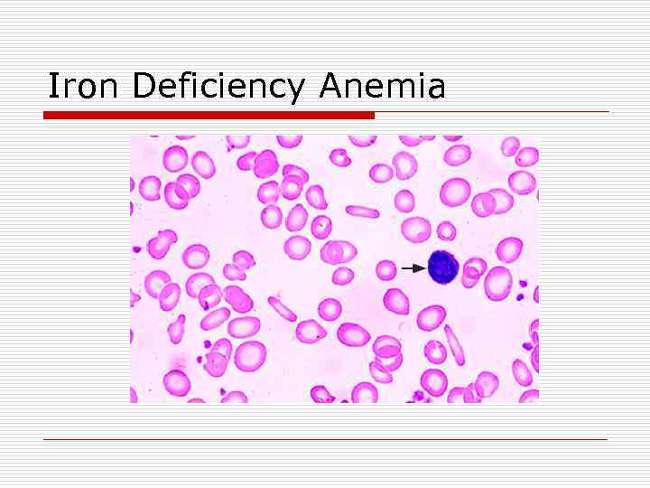 Iron Deficiency Anemia 