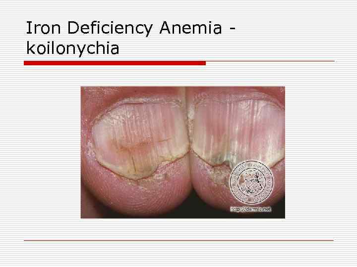 Iron Deficiency Anemia koilonychia 