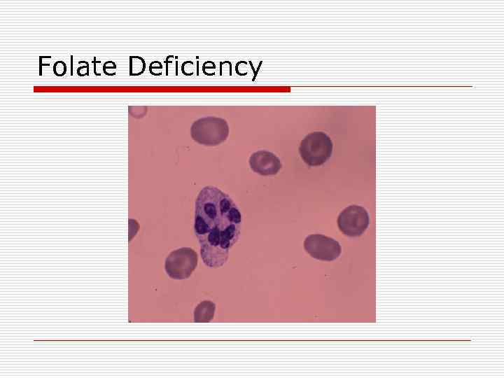 Folate Deficiency 