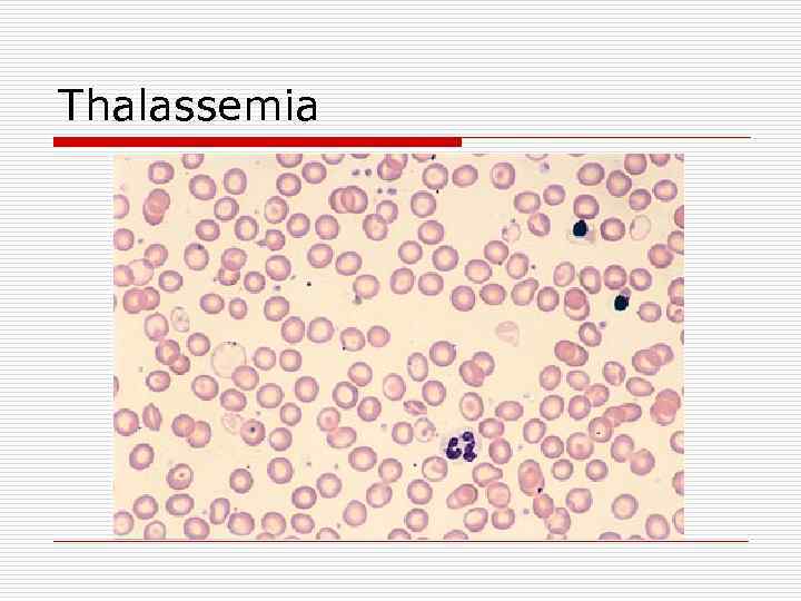 Thalassemia 