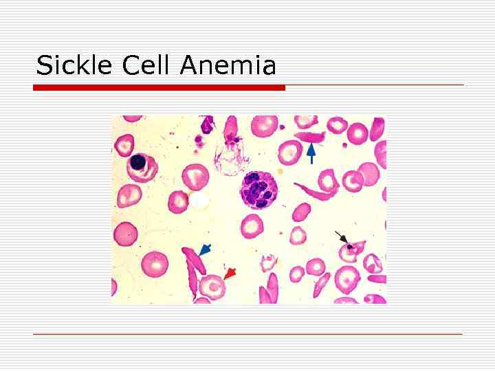 Sickle Cell Anemia 