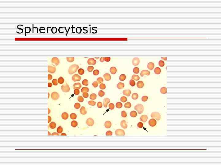 Spherocytosis 