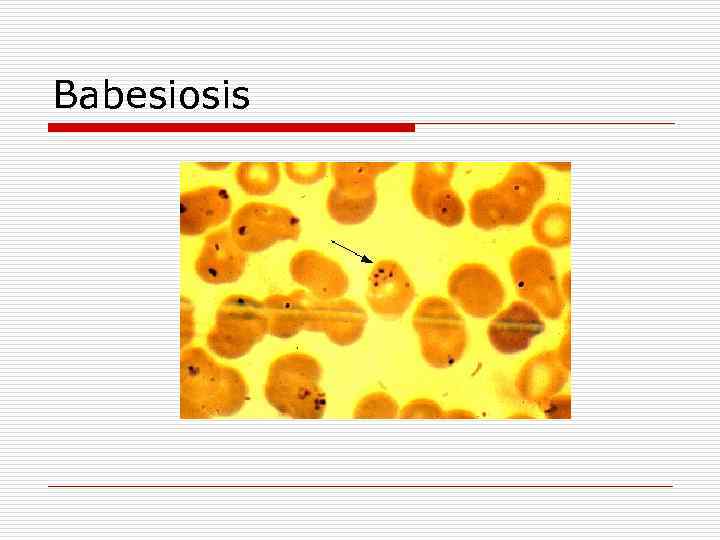 Babesiosis 