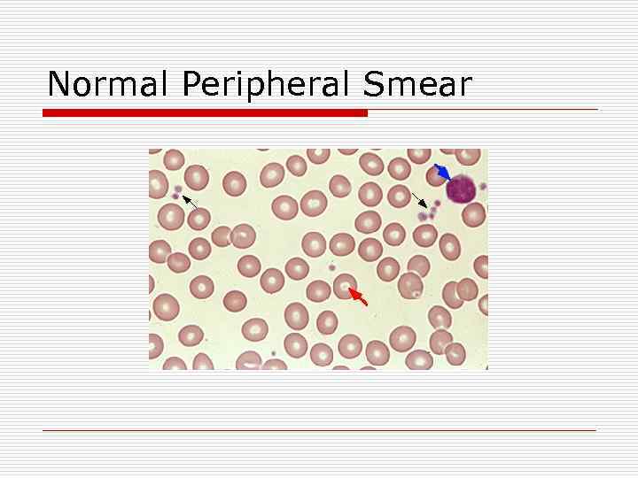 Normal Peripheral Smear 