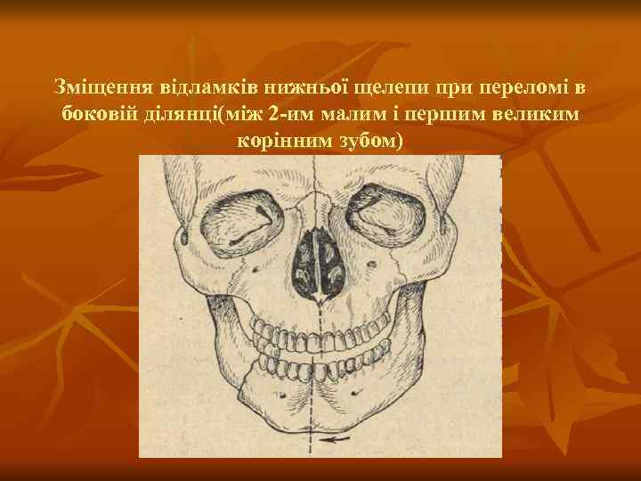 Зміщення відламків нижньої щелепи при переломі в боковій ділянці(між 2 -им малим і першим