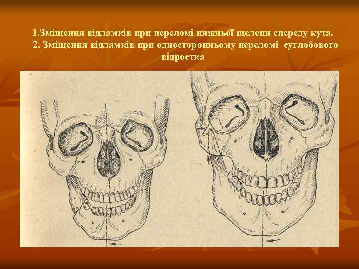 1. Зміщення відламків при переломі нижньої щелепи спереду кута. 2. Зміщення відламків при односторонньому