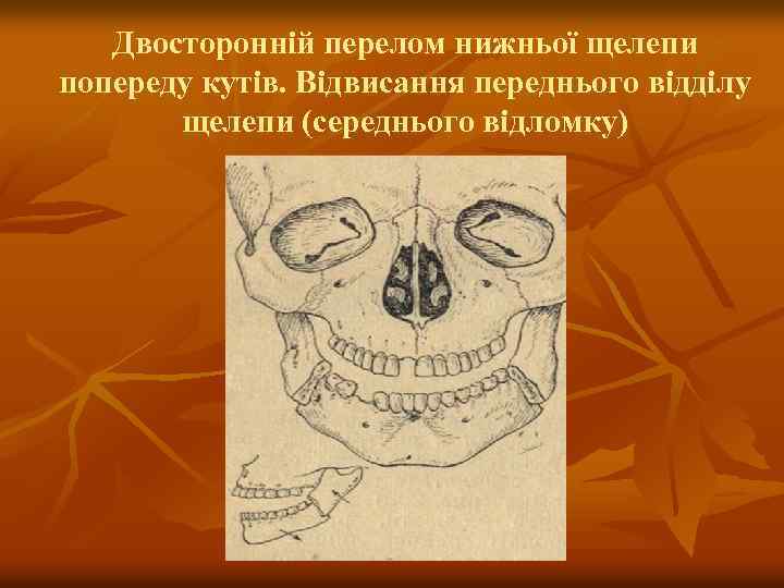 Двосторонній перелом нижньої щелепи попереду кутів. Відвисання переднього відділу щелепи (середнього відломку) 