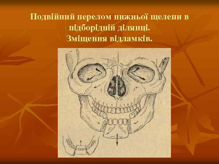 Подвійний перелом нижньої щелепи в підборідній ділянці. Зміщення відламків. 