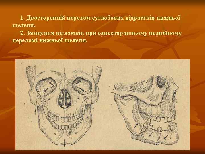 1. Двосторонній перелом суглобових відростків нижньої щелепи. 2. Зміщення відламків при односторонньому подвійному переломі