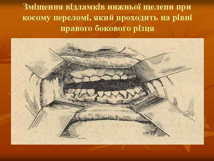 Зміщення відламків нижньої щелепи при косому переломі, який проходить на рівні правого бокового різця