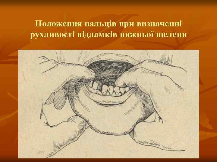 Положення пальців при визначенні рухливості відламків нижньої щелепи 