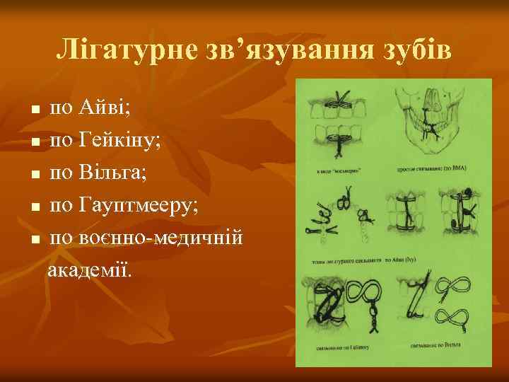 Лігатурне зв’язування зубів по Айві; n по Гейкіну; n по Вільга; n по Гауптмееру;