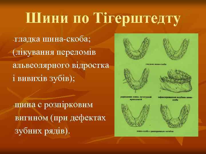 Шини по Тігерштедту гладка шина-скоба; (лікування переломів альвеолярного відростка і вивихів зубів); - шина