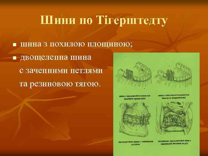 Шини по Тігерштедту шина з похилою площиною; n двощелепна шина с зачепними петлями та