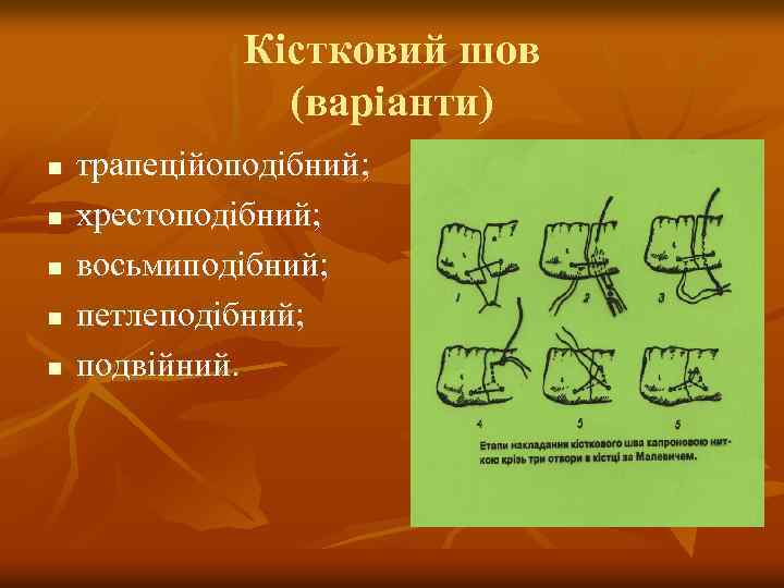 Кістковий шов (варіанти) n n n трапеційоподібний; хрестоподібний; восьмиподібний; петлеподібний; подвійний. 