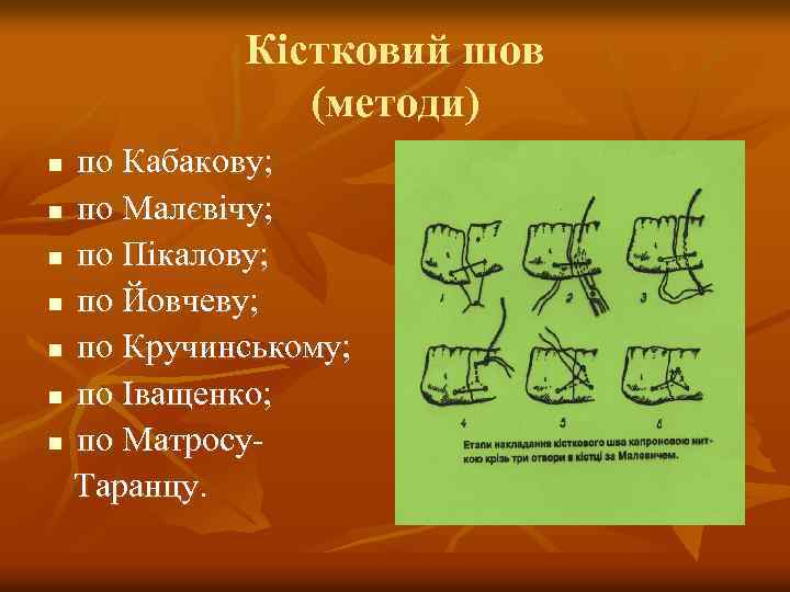 Кістковий шов (методи) по Кабакову; n по Малєвічу; n по Пікалову; n по Йовчеву;