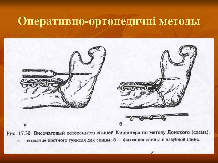 Оперативно-ортопедичні методы 