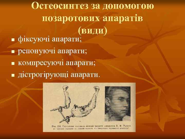 Остеосинтез за допомогою позаротових апаратів (види) n n фіксуючі апарати; репонуючі апарати; компресуючі апарати;