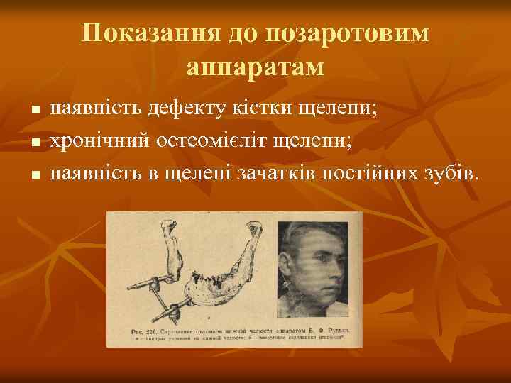 Показання до позаротовим аппаратам n n n наявність дефекту кістки щелепи; хронічний остеомієліт щелепи;