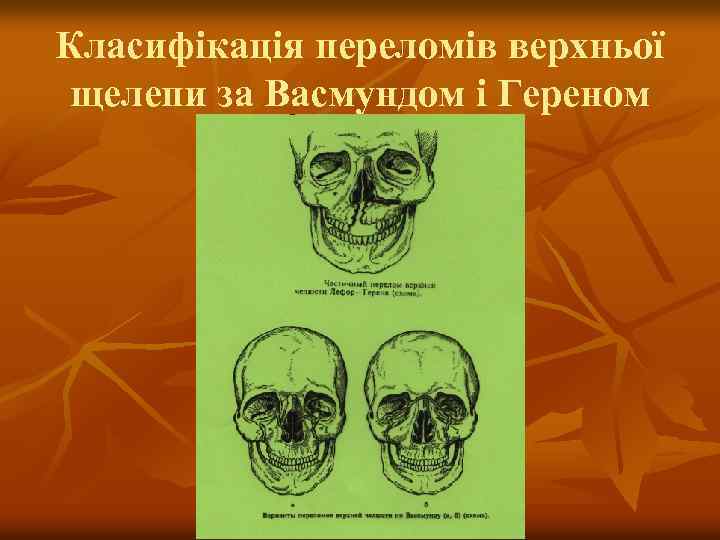 Класифікація переломів верхньої щелепи за Васмундом і Гереном 