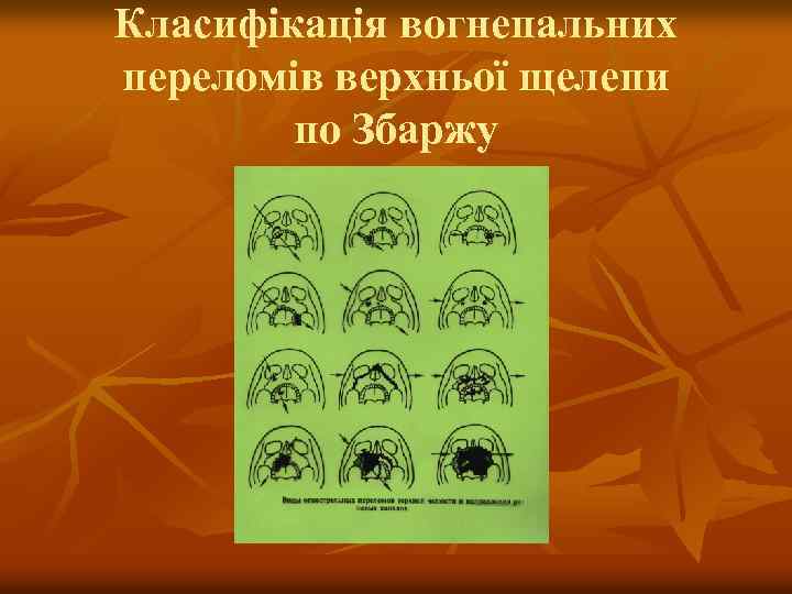 Класифікація вогнепальних переломів верхньої щелепи по Збаржу 