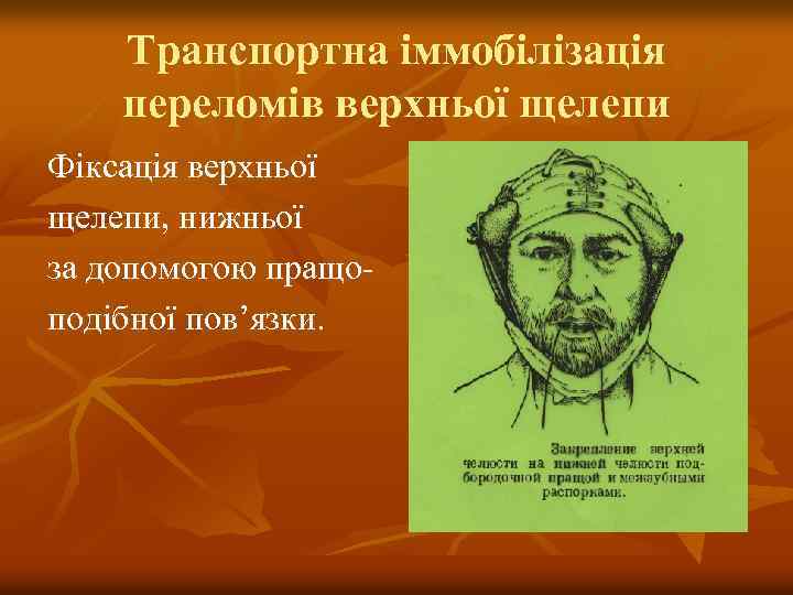 Транспортна іммобілізація переломів верхньої щелепи Фіксація верхньої щелепи, нижньої за допомогою пращоподібної пов’язки. 