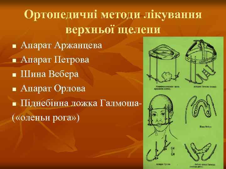 Ортопедичні методи лікування верхньої щелепи Апарат Аржанцева n Апарат Петрова n Шина Вебера n