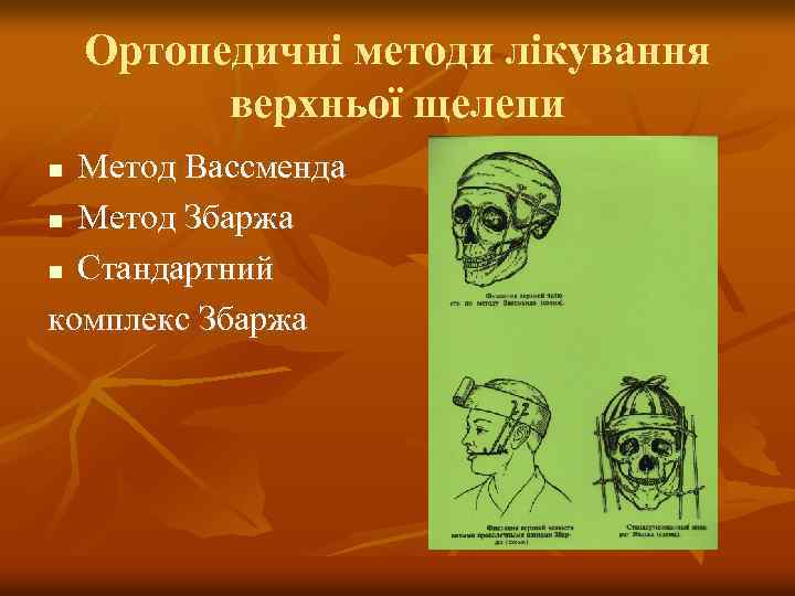 Ортопедичні методи лікування верхньої щелепи Метод Вассменда n Метод Збаржа n Стандартний комплекс Збаржа