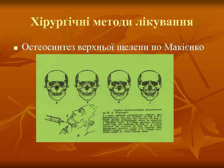 Хірургічні методи лікування n Остеосинтез верхньої щелепи по Макієнко 