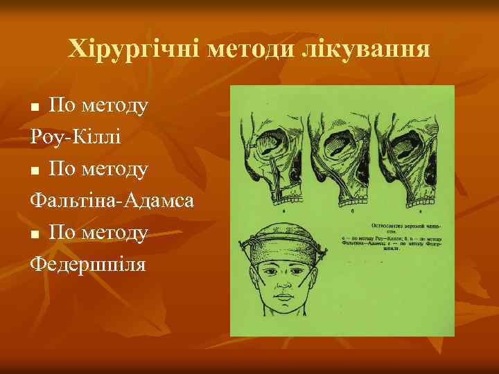 Хірургічні методи лікування По методу Роу-Кіллі n По методу Фальтіна-Адамса n По методу Федершпіля