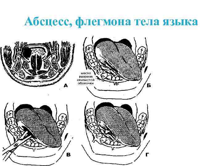 Абсцесс и флегмона. Вскрытие абсцесса корня языка. Параоссальная флегмона.