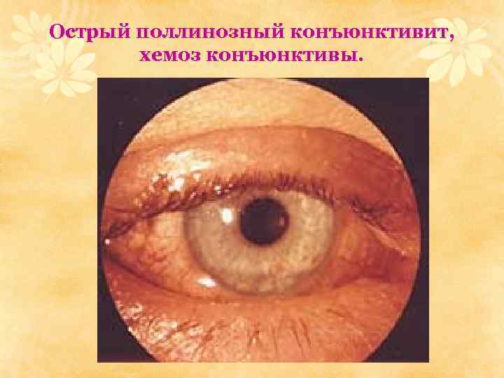 Острый поллинозный конъюнктивит, хемоз конъюнктивы. 